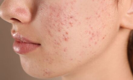 Tudo o que você precisa saber sobre as cicatrizes de acne! – Beleza