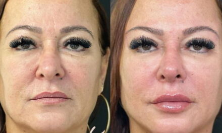 Mãe de Neymar, Nadine Gonçalves faz harmonização facial; compare o antes e o depois do tratamento – Lifestyle