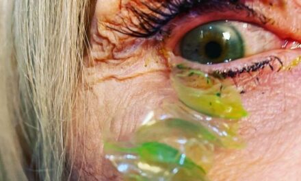 Como mulher não percebeu que tinha 23 lentes de contato no olho? Médica responde – Notícias